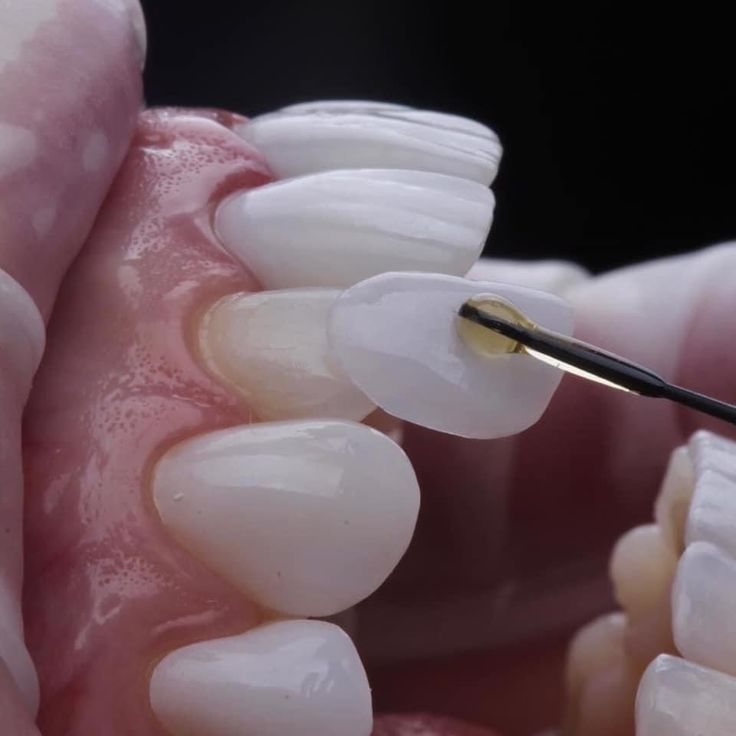Zirconia veneer/ inlay/ onlay