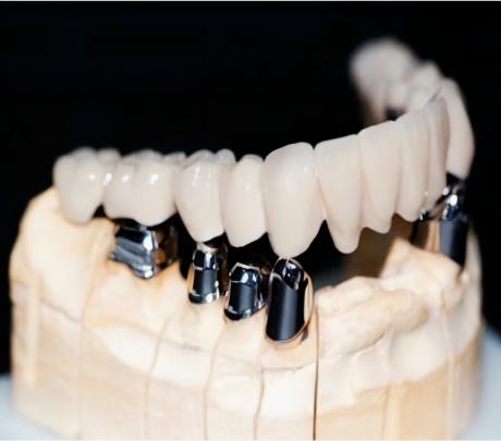 Implant Denture Series