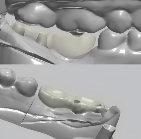 see how Ubest Dental to handle shorter abutment for implant case
